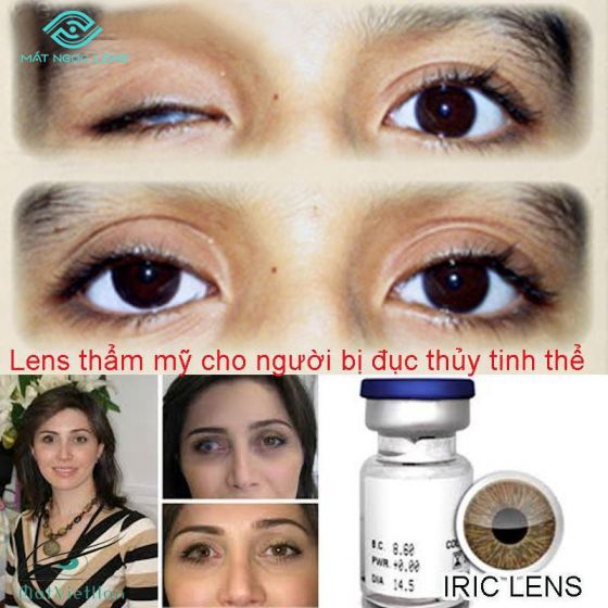 Lens thẩm mỹ